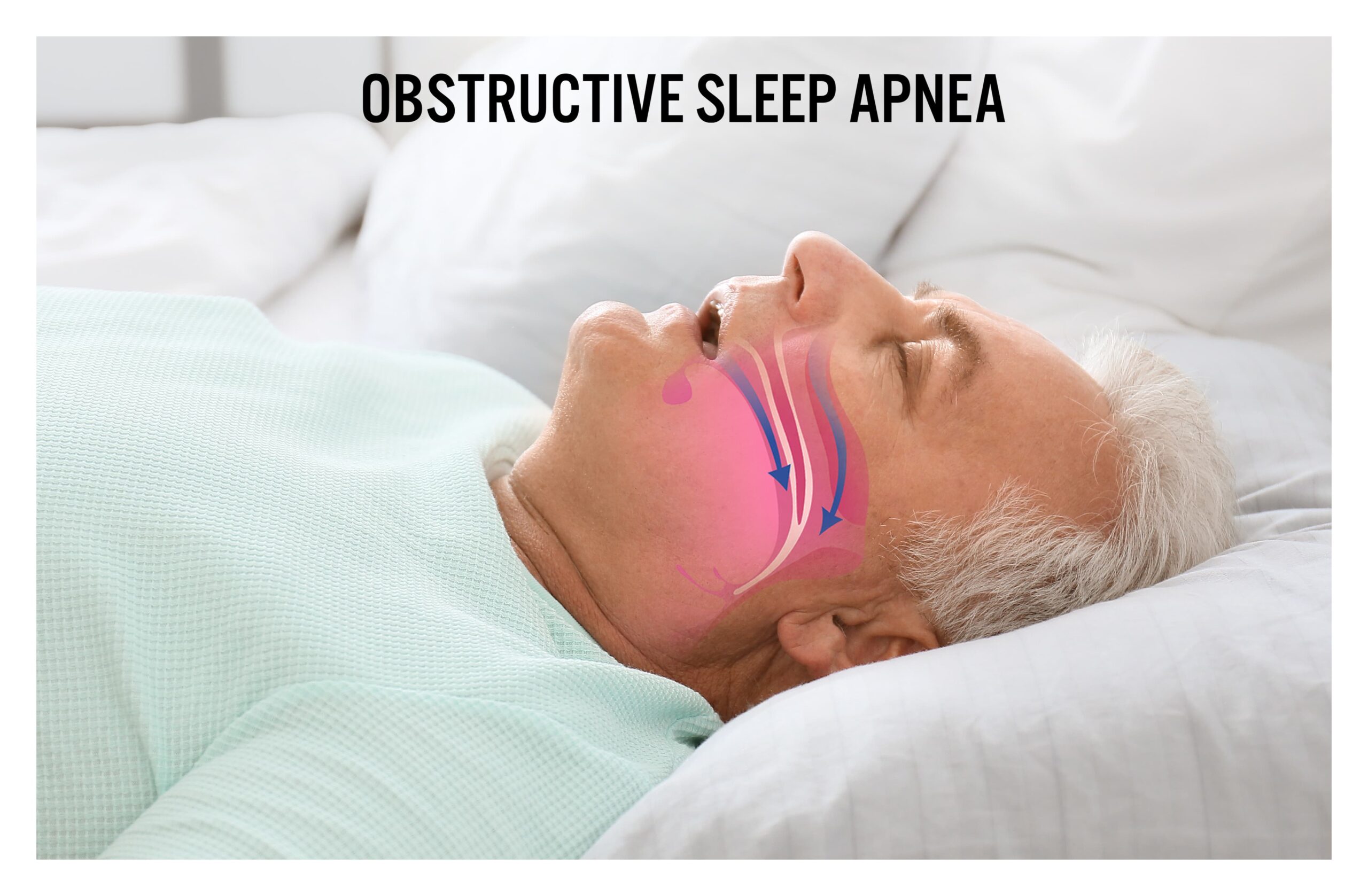 Diagram of Obstructive Sleep Apnea (OSA) mechanism